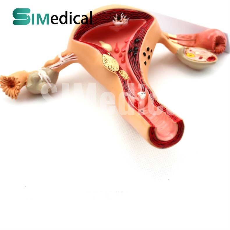 Uterus Ovary Model With Pathologies Anatomical Models Medical Models 0603